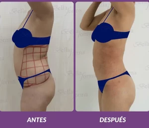 Lipoescultura-laser-min