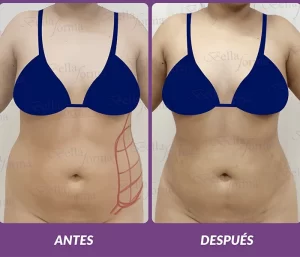 Lipoescultura-laser4-min