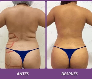Lipotransferencia-laser-min