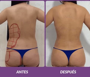 Lipotransferencia-laser2-min